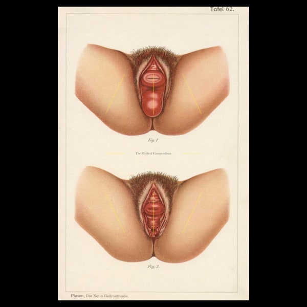Antique gynaecological illustration. Medical decor. Genitalia. Uterine prolapse. Perineal tear. Vagina anatomy. Pelvic organ prolapse. 1905