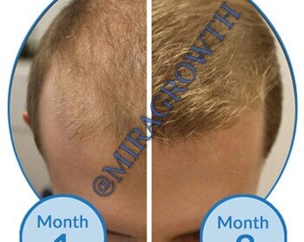 balding etsy
