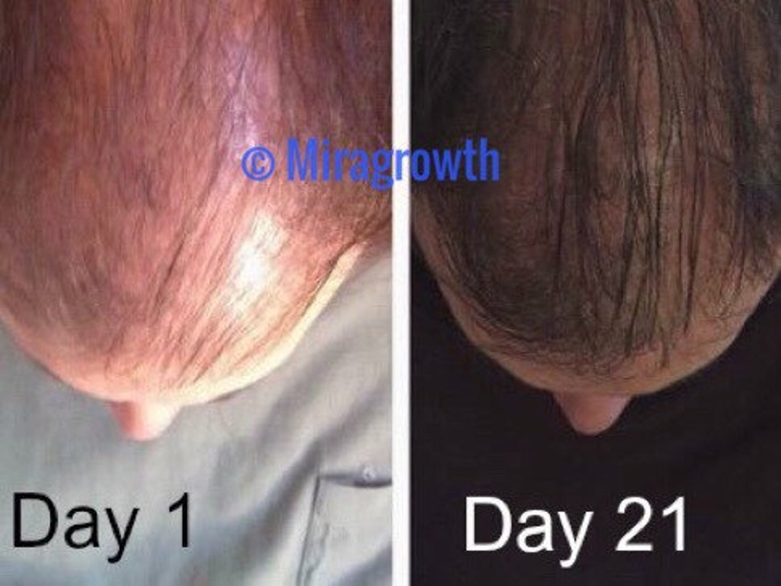 Image showcasing Mens Hair Growth Solution Oil Serum Hair Loss Products Receding ...