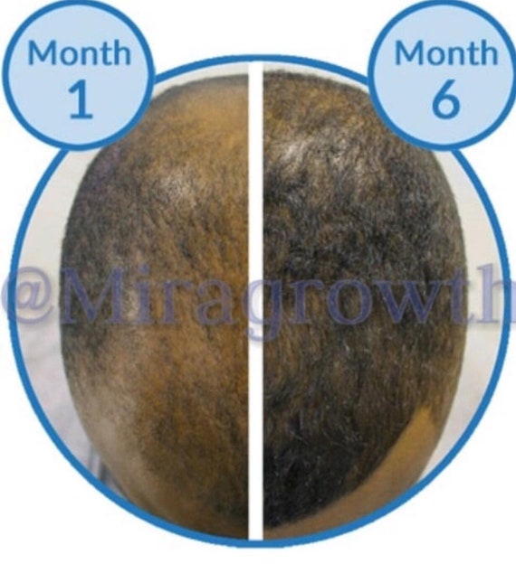 Hair Growth Oil Serum Hair Loss Treatment For Men Or Women Etsy