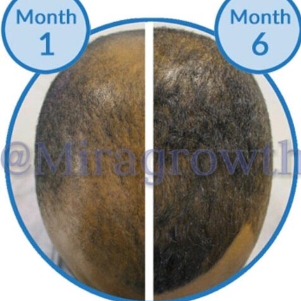 Mens Hair Growth Solution Oil Serum Hair Loss Products Receding Hairline Bald Spots Balding Thinning Hair 1 Month Supply