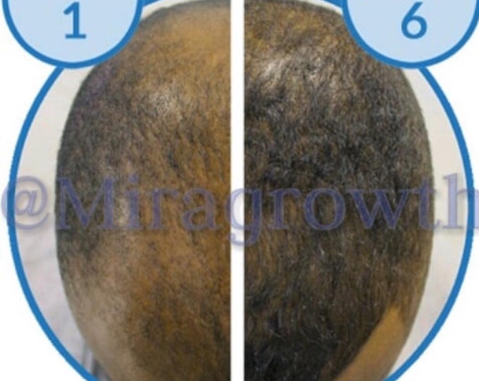Image showcasing Mens Hair Growth Solution Oil Serum Hair Loss Products Receding ...