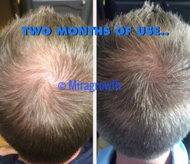 Mens Hair Growth Solution Oil Serum Hair Loss Products Receding