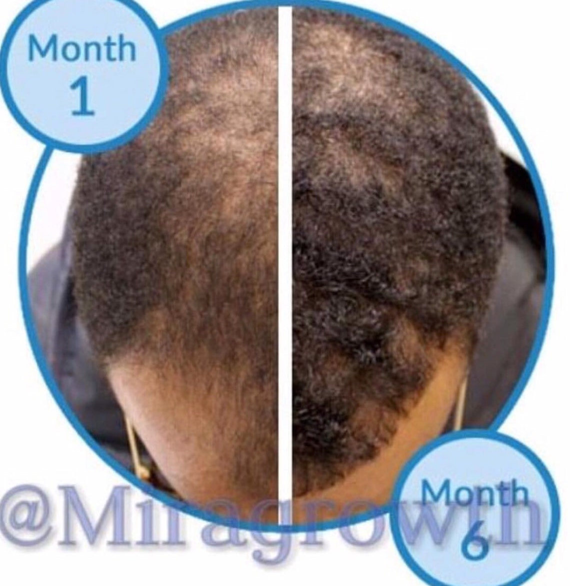 View of Mens Hair Growth Solution Oil Serum Hair Loss Products Receding ...