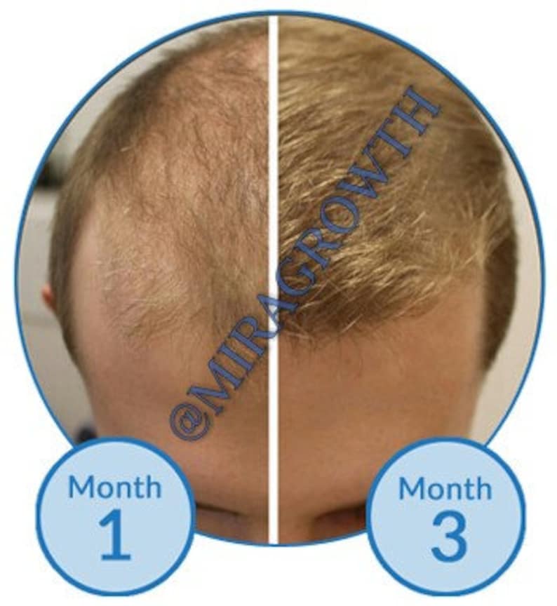 Mens Hair Growth Solution Oil Serum Hair Loss Products Receding