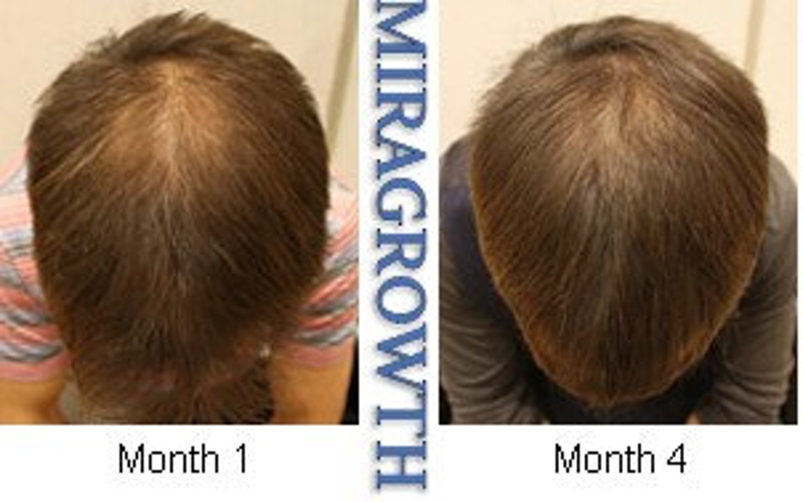 Mens Hair Growth Solution Oil Serum Hair Loss Products Receding ...