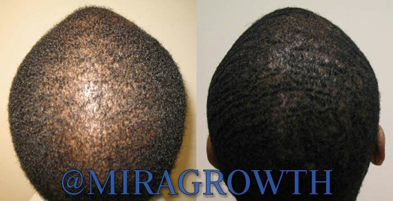 View of Mens Hair Growth Solution Oil Serum Hair Loss Products Receding ...