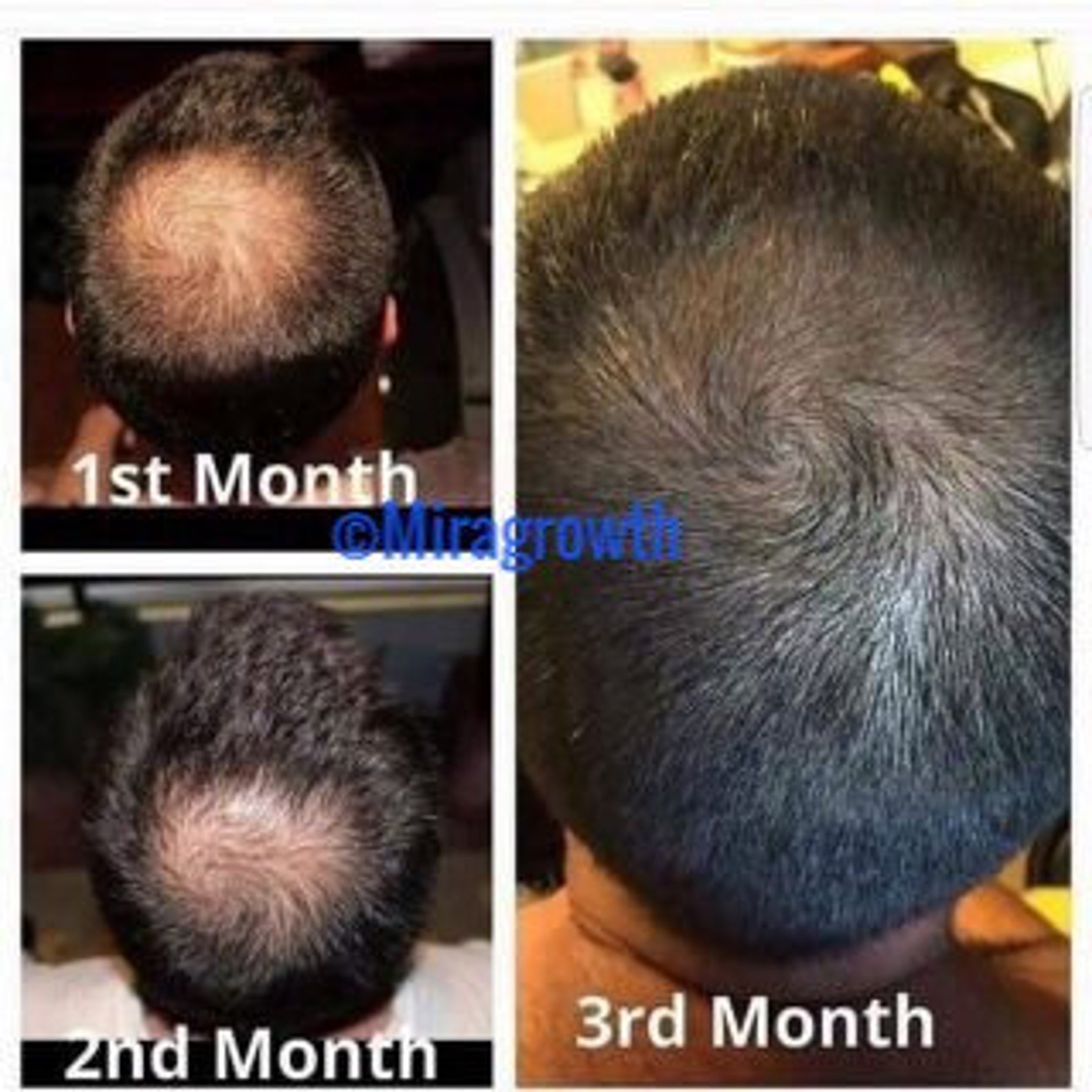 Image showcasing Mens Hair Growth Solution Oil Serum Hair Loss Products Receding ...