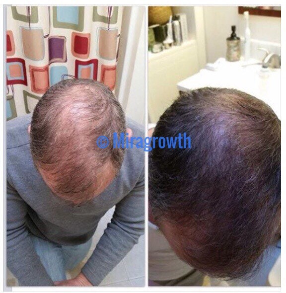 Image showcasing Mens Hair Growth Solution Oil Serum Hair Loss Products Receding ...