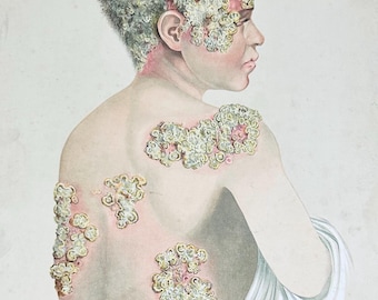 19th Century Dermatology Print – Favus, E. Burgess Chromolithograph