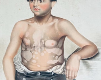 19th Century Dermatology Print – Leucoderma, E. Burgess Chromolithograph