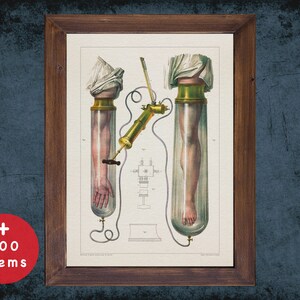 Vintage Cupping Therapy Anatomy Art Print: Medical Decor