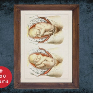 PREGNANCY BREECH PRESENTATION impresión de arte de anatomía para estudiante de medicina graduado, partea y obstetricia médico decoración de la oficina de regalos