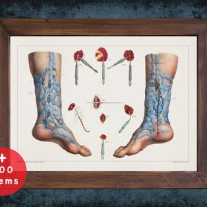 Varicose Veins Anatomy Art Print: French Medical Decor