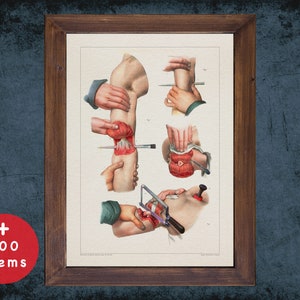 ARM AMPUTATION  anatomy art print for medical student gift, surgeon gift and surgery art doctor office decor
