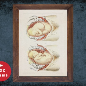 SCHWANGERSCHAFT BREECH BABY Anatomie Kunstdruck für Medizinstudent Absolvent, Hebamme und Geburtshilfe Arzt Geschenk Büro Dekor