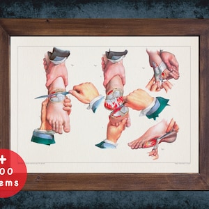 May include: A vintage medical illustration showing a detailed anatomical diagram of a human ankle and foot. The illustration depicts various stages of a surgical procedure, with the ankle and foot being bandaged and stitched.