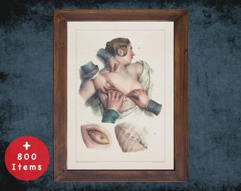 Mastectomy Anatomy Art Print: Vintage Medical Decor