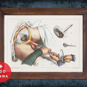 BLADDER STONE SURGERY anatomy art print for medical student graduate, Urologist and Urology doctor gift office decor