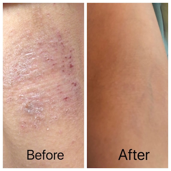 Mitlow Herbal Eczema Balm ! Natural Eczema Relief Cream for Chronic Eczema Dermatitis Itching Rash & Moisturizer for Dry Skin~ Stops Itching