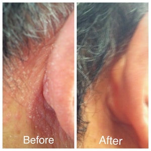 Mitlow Herbal Oil to reduce Hair fall dandruff and scalp irritation
