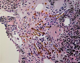 Amiantose du poumon | Histologie Pathologie Cytologie Technicien de laboratoire médical Médecine Maladie Art Cadeau Impression Peinture Science Cellules