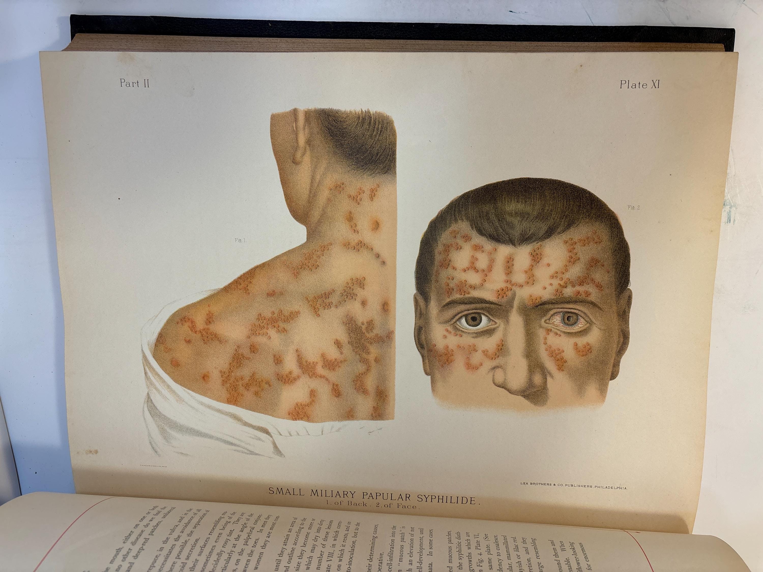 A Clinical Atlas of Venereal & Skin Diseases Including Diagnosis, Prognosis & Treatment. Illustrated with Two Hundred and Thirteen Figures, Many of Them Life Size, on Fifty-Eight Beautifully Colored Plates. Also, Many Large and Carefully Executed Engravings in The Text. — photograph 5.