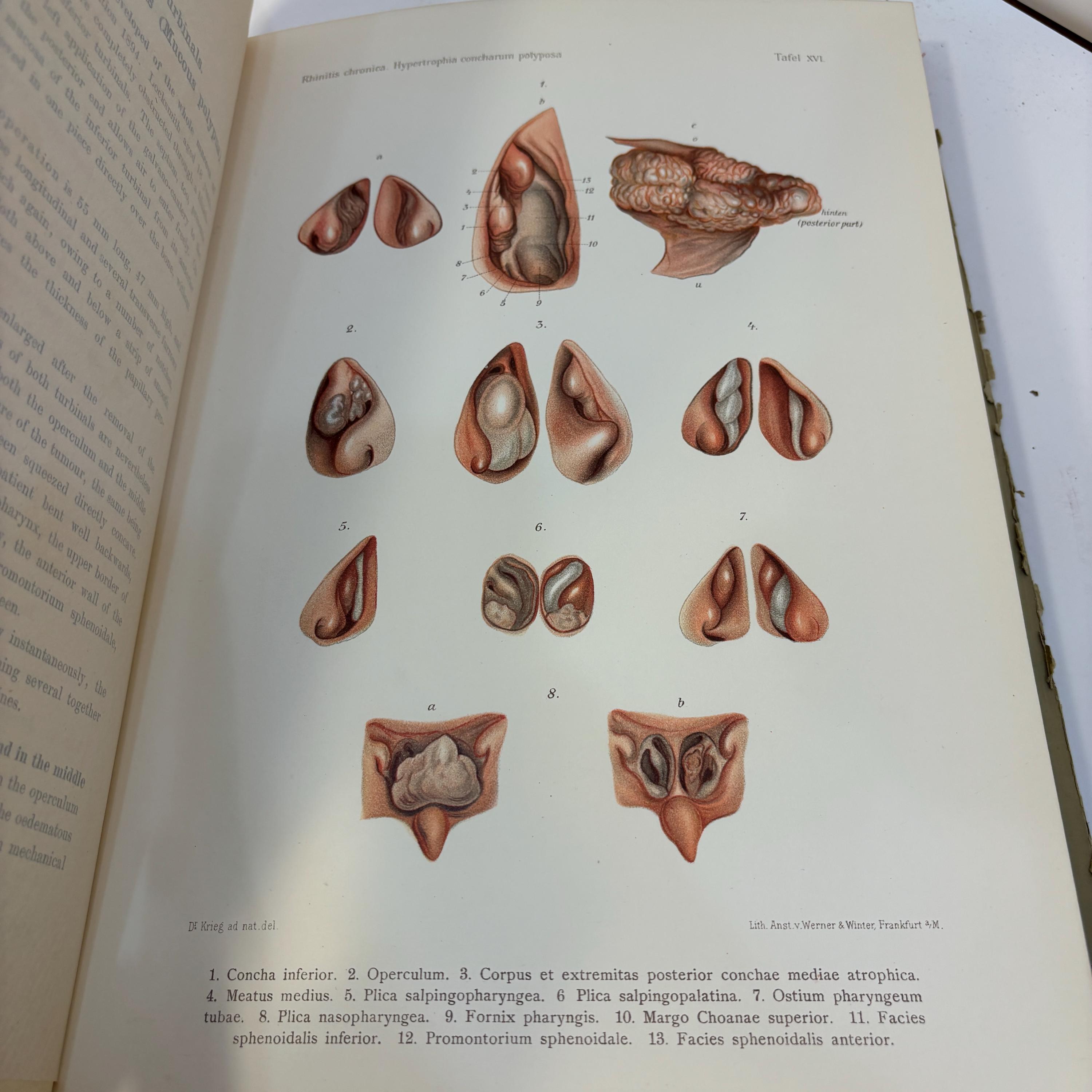 Atlas of Diseases of The Nose with 38 Coloured Plates and 475 Illustrations. Original Sketches Coloured and Described by Robert Krieg. With German and English Text. English Translation by Alphonse Roman — photograph 6.