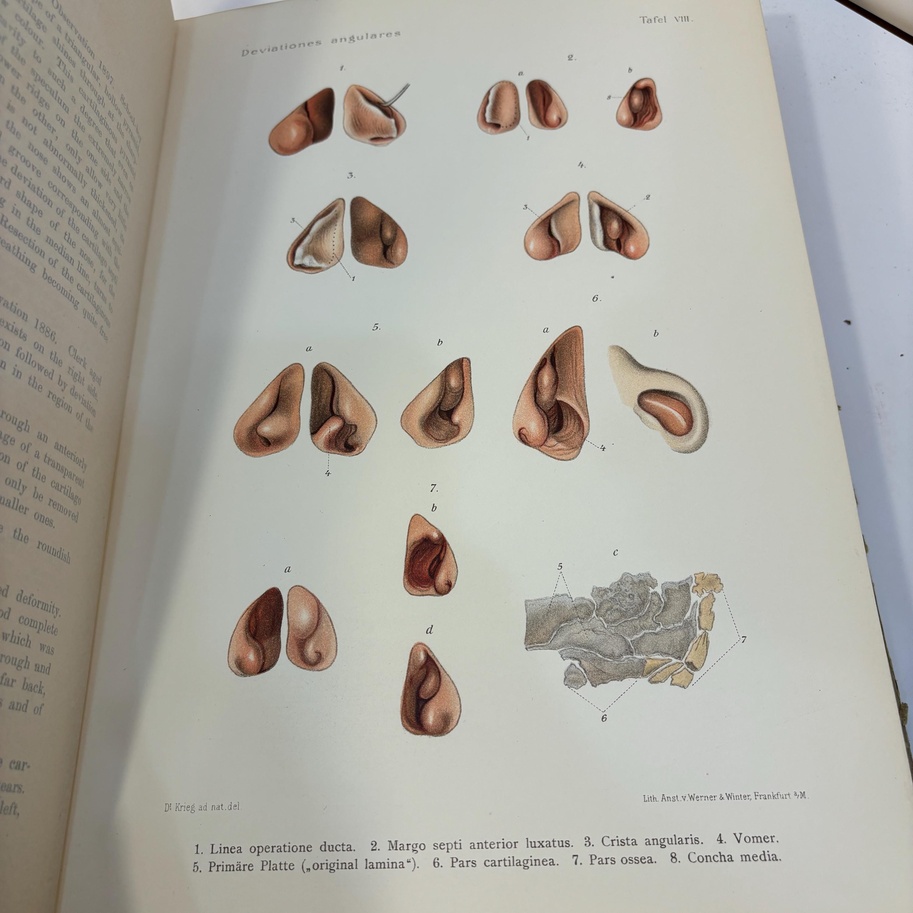 Atlas of Diseases of The Nose with 38 Coloured Plates and 475 Illustrations. Original Sketches Coloured and Described by Robert Krieg. With German and English Text. English Translation by Alphonse Roman — photograph 10.