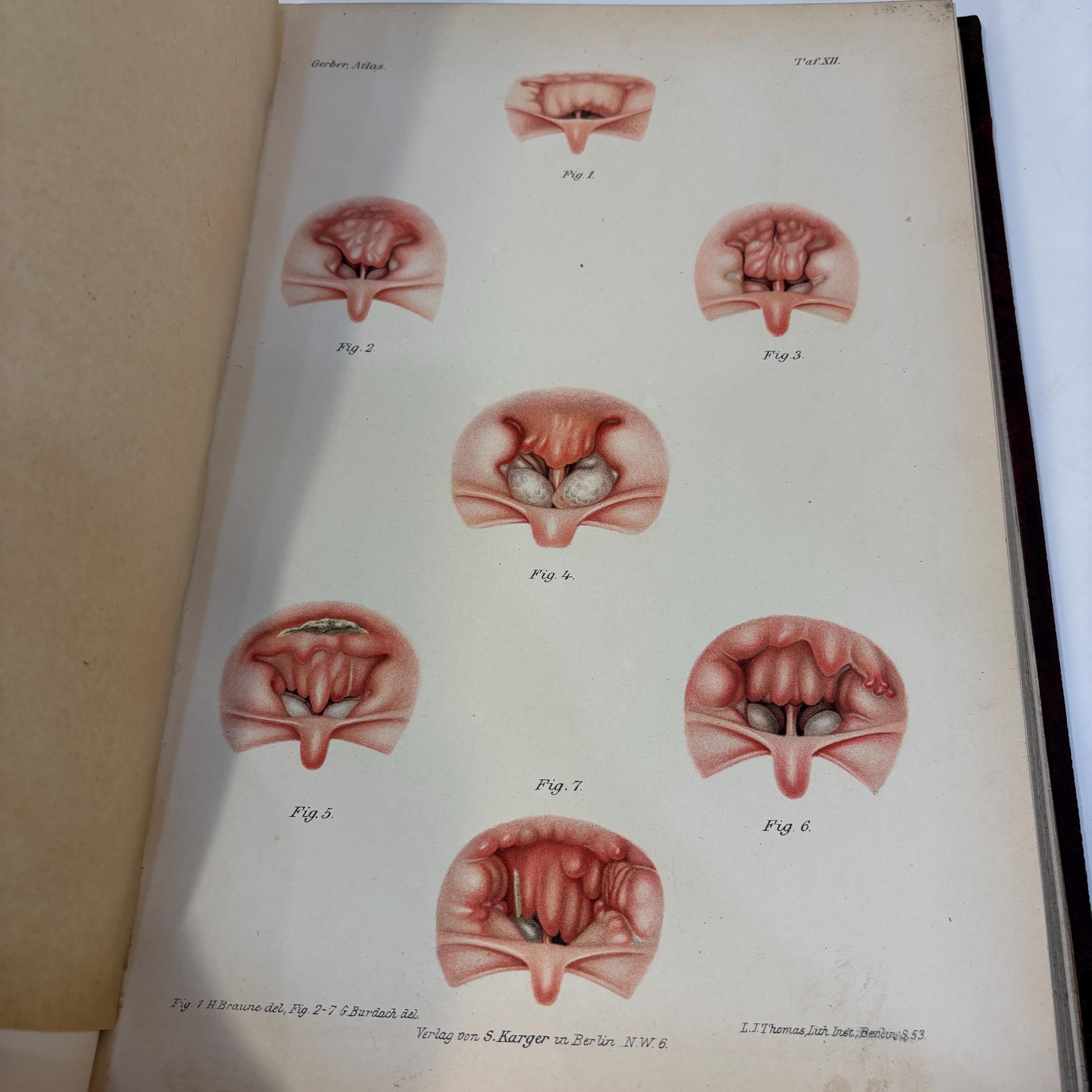 Atlas der Krankheiten der Nase, ihrer Nebenhöhlen und des Nasenrachenraumes. 363 Figuren auf 42 Tafeln Mit erläuterndem Text. Von Privatdocent Dr. P. H. Gerber Spezialarzt für Nasen-, Ohren- und Halskrankheiten in Königsberg i. Pr. Korrespondierendes Mitglied der Laryngologischen Gesellschaft zu Berlin und der französischen Gesellschaft für Otologie, Rhinologie und Laryngologie zu Paris. Translated: Atlas of the Diseases of the Nose, Its Accessory Sinuses and the Nasopharyngeal Cavity. 363 Illustrations on 42 Plates With Explanatory Text. By Privatdozent Dr. P. H. Gerber Specialist in Diseases of the Nose, Ears, and Throat in Königsberg, Prussia. Corresponding Member of the Laryngological Society of Berlin and of the French Society for Otology, Rhinology, and Laryngology in Paris. — photograph 5.