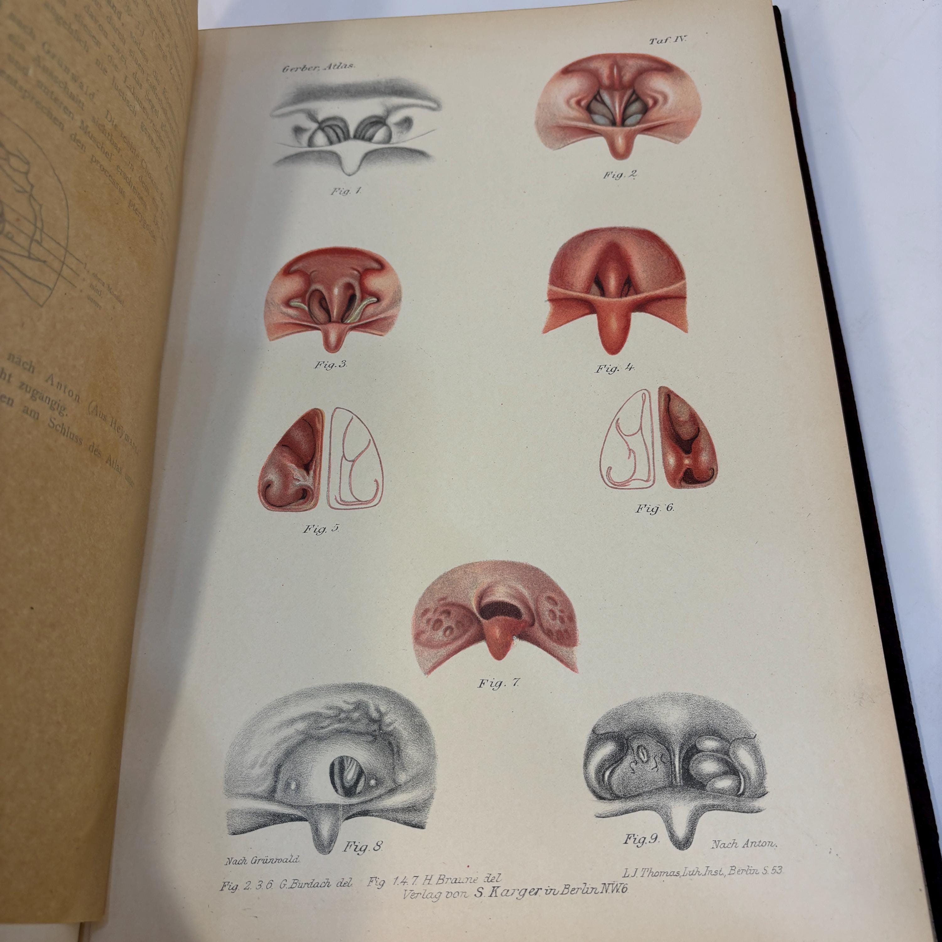 Atlas der Krankheiten der Nase, ihrer Nebenhöhlen und des Nasenrachenraumes. 363 Figuren auf 42 Tafeln Mit erläuterndem Text. Von Privatdocent Dr. P. H. Gerber Spezialarzt für Nasen-, Ohren- und Halskrankheiten in Königsberg i. Pr. Korrespondierendes Mitglied der Laryngologischen Gesellschaft zu Berlin und der französischen Gesellschaft für Otologie, Rhinologie und Laryngologie zu Paris. Translated: Atlas of the Diseases of the Nose, Its Accessory Sinuses and the Nasopharyngeal Cavity. 363 Illustrations on 42 Plates With Explanatory Text. By Privatdozent Dr. P. H. Gerber Specialist in Diseases of the Nose, Ears, and Throat in Königsberg, Prussia. Corresponding Member of the Laryngological Society of Berlin and of the French Society for Otology, Rhinology, and Laryngology in Paris. — photograph 7.