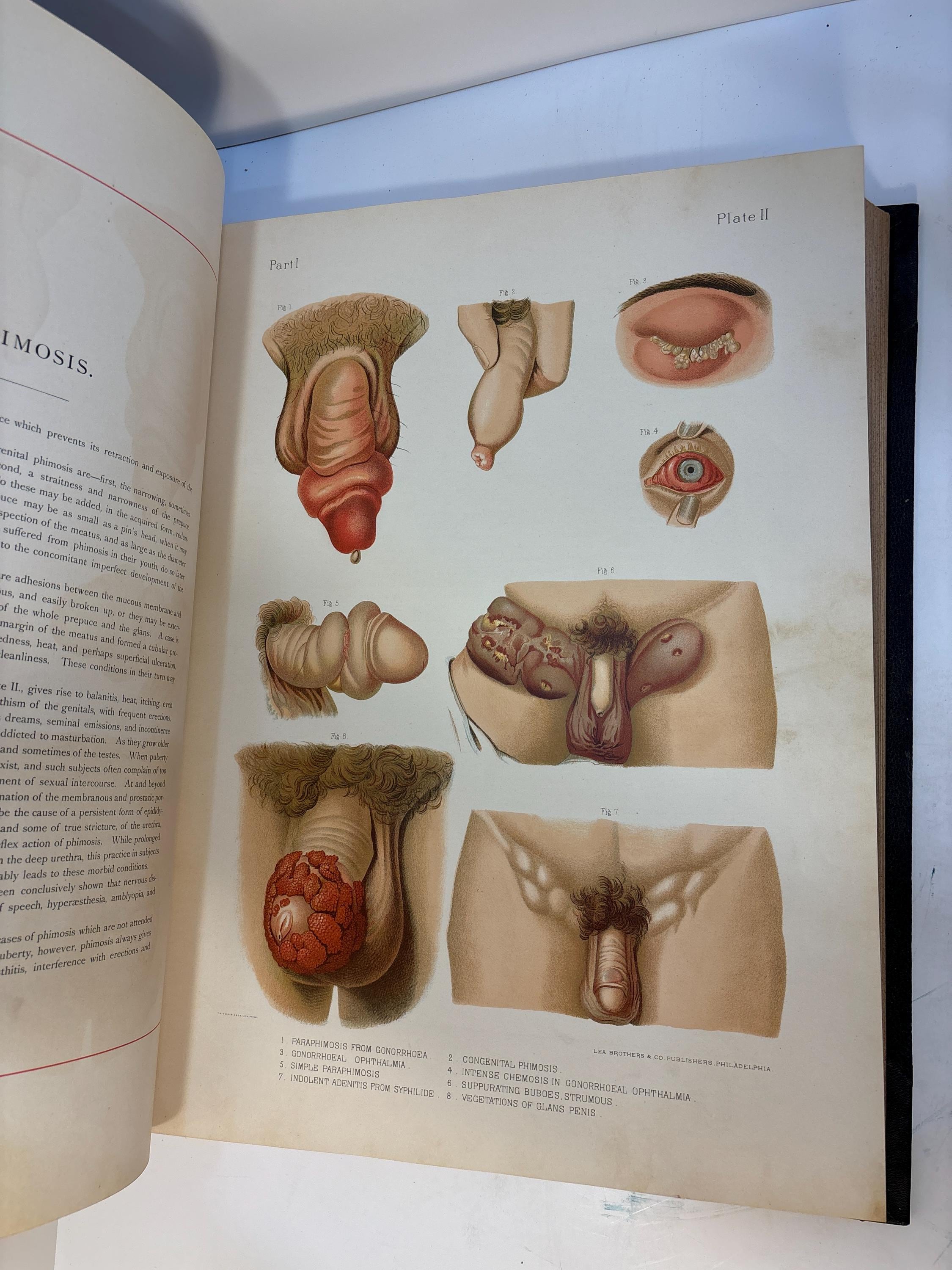 A Clinical Atlas of Venereal & Skin Diseases Including Diagnosis, Prognosis & Treatment. Illustrated with Two Hundred and Thirteen Figures, Many of Them Life Size, on Fifty-Eight Beautifully Colored Plates. Also, Many Large and Carefully Executed Engravings in The Text. — photograph 7.