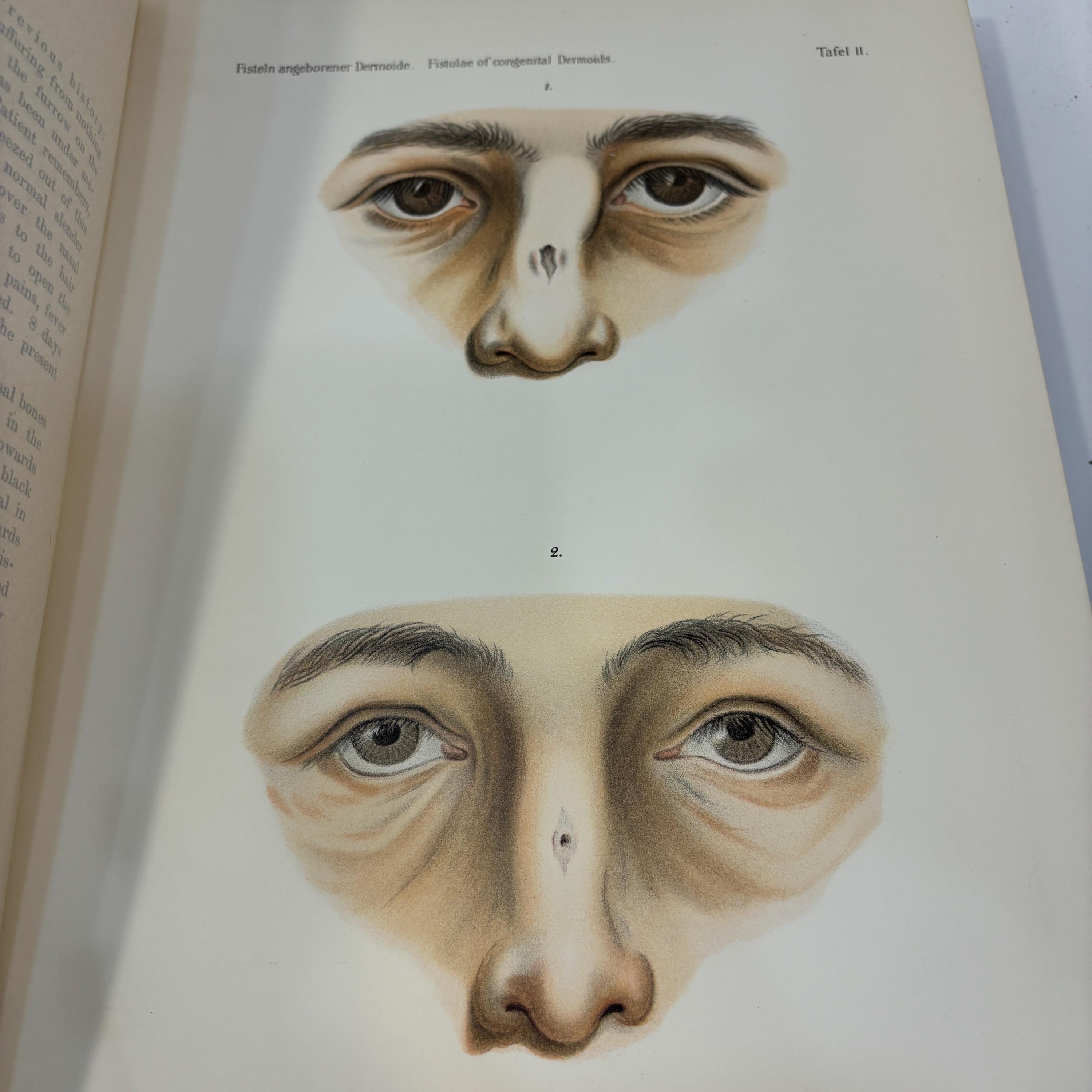Atlas of Diseases of The Nose with 38 Coloured Plates and 475 Illustrations. Original Sketches Coloured and Described by Robert Krieg. With German and English Text. English Translation by Alphonse Roman — photograph 8.