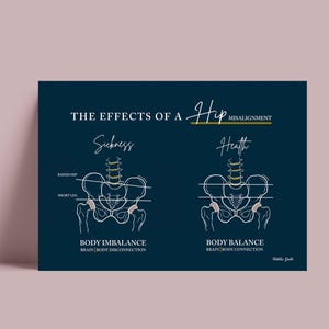Hip Misalignment Print // Spinal Nerve Chart // Chiropractic // Subluxation // Nervous System // Healing // Hip Misalignment // Anatomy