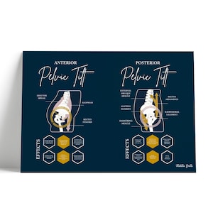 Pelvic Tilt // Chiropractic // Anterior Pelvic Tilt  // Spine // Anatomy Print // Vitalistic Chiro // Chiropractic Prints