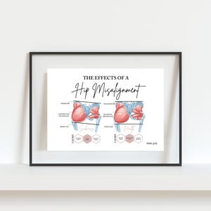 Hip Misalignment Print // Spinal Nerve Chart // Chiropractic // Subluxation // Nervous System // Healing // Hip Misalignment // Anatomy