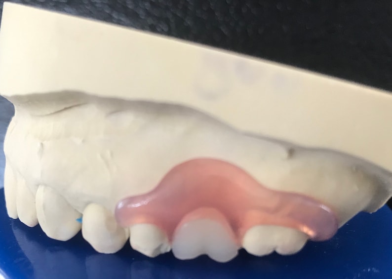 Custom Mini Nesbit Partial False Tooth Flipper Denture Aesthetic Missing Ultra Thin Teeth Comfort Valplast Comfortable Dental