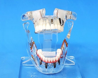 Sinuses Lift 7 Implants 2 Bridges Dental Combo Model