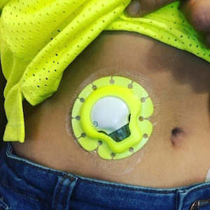 Könnte beinhalten: Nahaufnahme eines gelben medizinischen Geräts mit einer durchsichtigen Plastikabdeckung, das am Bauch einer Person befestigt ist. Das Gerät wird auf der Haut getragen und hat einen kleinen, weißen, runden Knopf in der Mitte.