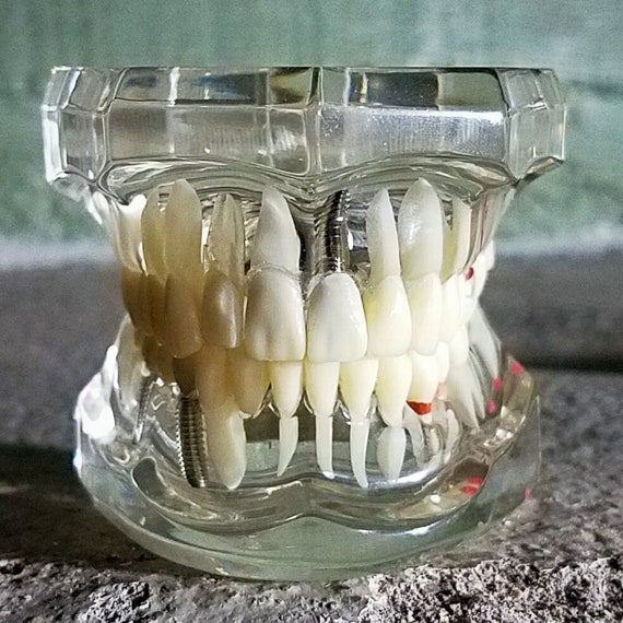 Disease Teeth Model, Dental Mold, Clear Dental Teeth Model, Vintage Medical  