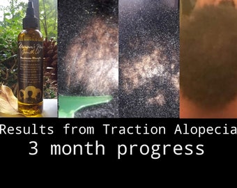 Hair Growth Shampoo For Alopecia Thinning Hair Dry Scalp Etsy