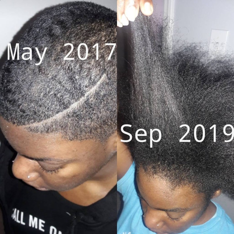 Formulated With 15 Of The Strongest Herbs For Bald Spots Etsy