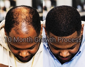 FOR MAXIMUM GROWTH -  Chebe Powder Batana Oil Hair Growth Oil for Sensitive Scalp - Hair Stylist Formula - Free Shipping