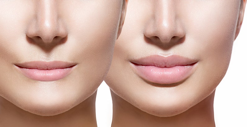 Pin on Nurse injector Botox lips, Lip fillers juvederm, Lip fillers