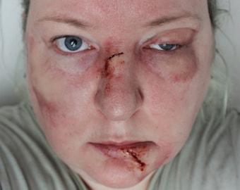 Op de afbeelding: Een close-up van het gezicht van een vrouw met zichtbare verwondingen, waaronder een snee op haar neus en een blauwe plek in haar oog. De vrouw heeft rode, gezwollen huid en een snee op haar lip.
