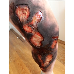 May include: A close-up of a leg with a large burn injury. The skin is charred black and red, with some areas of raw flesh exposed.