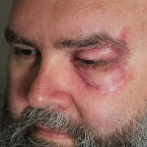 May include: Close-up of a man's face showing a large, red, swollen area around his eye. The area is discolored and has a purplish hue.