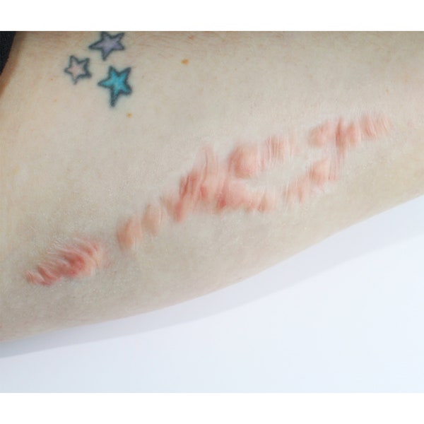 Keloid Scar 2 Silicone Prosthetic // Encapsulated Silicone Appliance, Latex Free // Healed Scar Wound Injury // Film and TV SFX MAKEUP