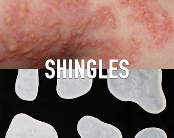 6 Shingles Silicone Bondo Moulds for professional makeup artists to fill yourself //Film & TV // Irritation Skin Reaction Rash