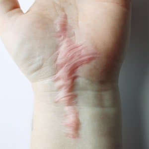 May include: A close-up of a person's wrist with a long, raised, pink scar.